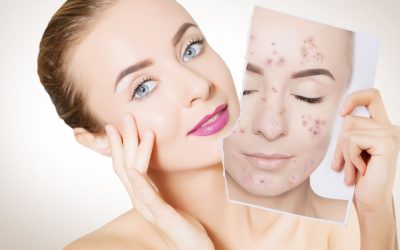 Acne e Saúde Intestinal: O Papel do Microbioma na Redução da Inflamação