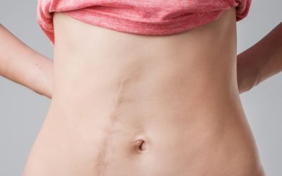 Terapia Sacro-Craniana: Alívio da Dor e Libertação de Aderências Pós-Cirúrgicas