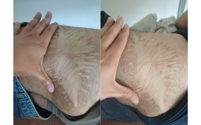 Quando uma cicatriz antiga começa a mexer, o corpo também muda